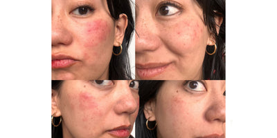 Red Light Therapy Over-Exposure