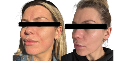 Micro-Needling Facial