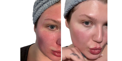 Chemical Peel Burn